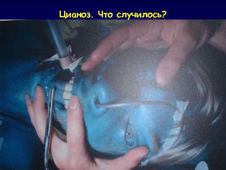 Цианоз. Что случилось? 