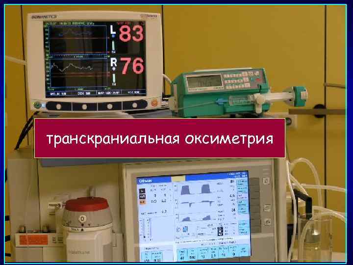 транскраниальная оксиметрия 