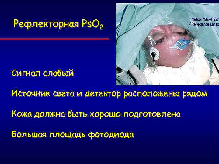Рефлекторная Ps. O 2 Сигнал слабый Источник света и детектор расположены рядом Кожа должна