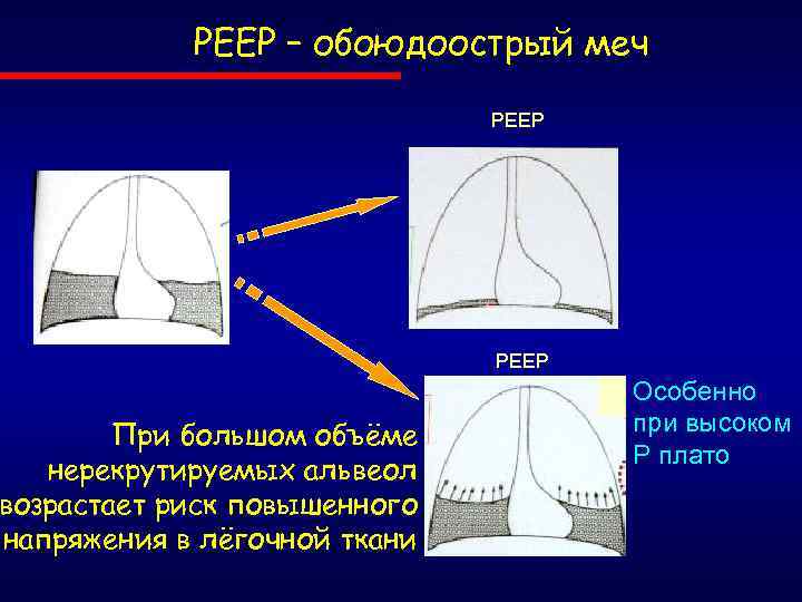 РЕЕР – обоюдоострый меч При большом объёме нерекрутируемых альвеол возрастает риск повышенного напряжения в