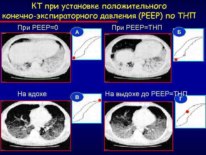КТ при установке положительного конечно-экспираторного давления (РЕЕР) по ТНП При РЕЕР=0 На вдохе А