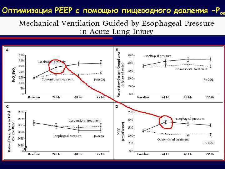 Оптимизация РЕЕР с помощью пищеводного давления -Рое 