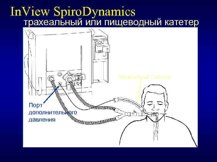 In. View Spiro. Dynamics трахеальный или пищеводный катетер Intratracheal Catheter Порт дополнительного давления 