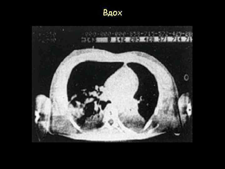 Вдох 
