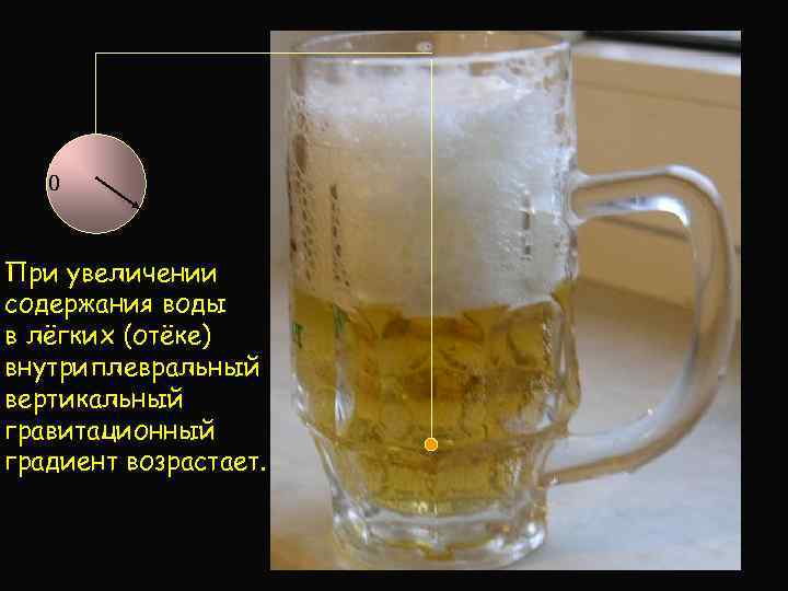 0 При увеличении содержания воды в лёгких (отёке) внутриплевральный вертикальный гравитационный градиент возрастает. 