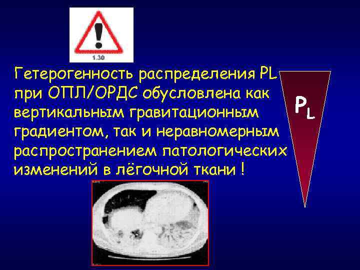 Гетерогенность распределения PL при ОПЛ/ОРДС обусловлена как вертикальным гравитационным градиентом, так и неравномерным распространением
