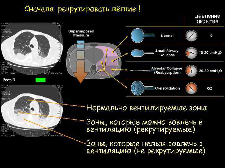 Сначала рекрутировать лёгкие ! давление окрытия Нормально вентилируемые зоны Зоны, которые можно вовлечь в