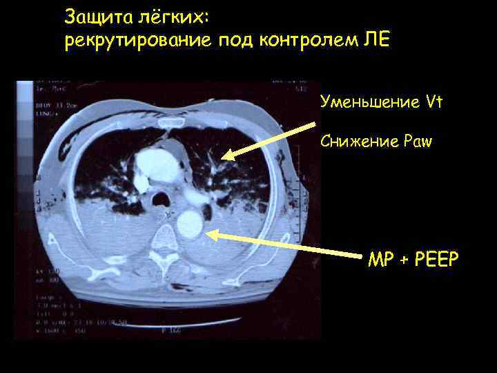 Защита лёгких: рекрутирование под контролем ЛЕ Уменьшение Vt Снижение Paw МР + РЕЕР 