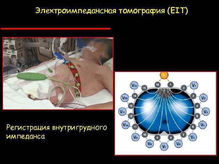 Электроимпедансная томография (EIT) Регистрация внутригрудного импеданса 