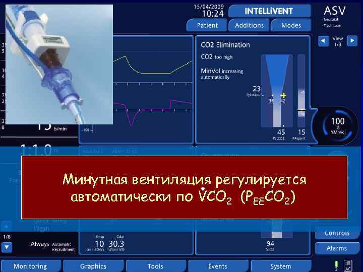 Минутная вентиляция регулируется автоматически по VCO 2 (PEECO 2) 