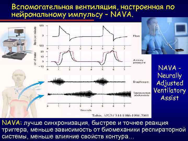 Вспомогательная вентиляция, настроенная по нейрональному импульсу – NAVA Neurally Adjusted Ventilatory Assist NAVA: лучше