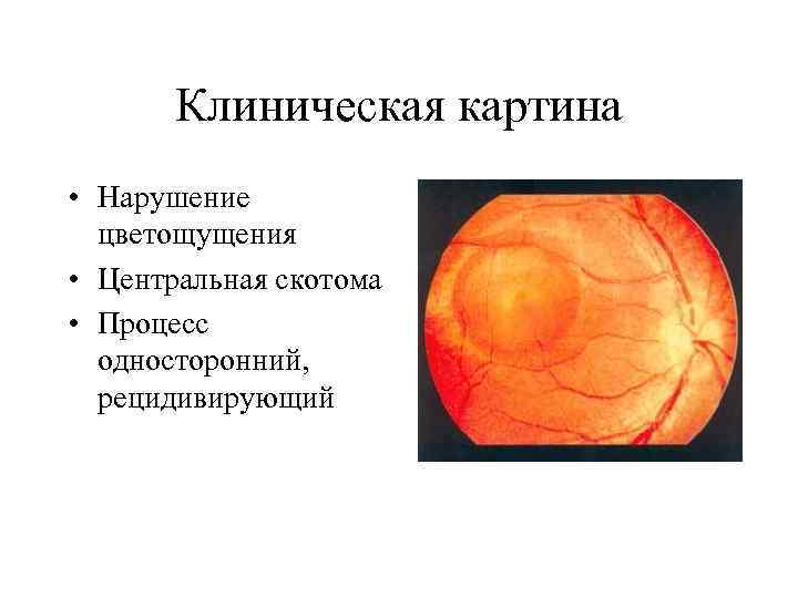 Клиническая картина • Нарушение цветощущения • Центральная скотома • Процесс односторонний, рецидивирующий 