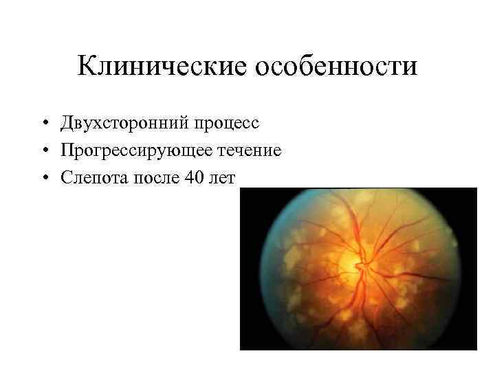 Клинические особенности • Двухсторонний процесс • Прогрессирующее течение • Слепота после 40 лет 