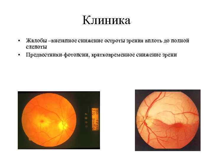 Клиника • Жалобы –внезапное снижение остроты зрения вплоть до полной слепоты • Предвестники-фотопсии, кратковременное