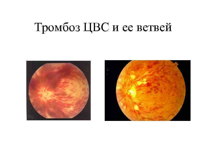 Тромбоз ЦВС и ее ветвей 
