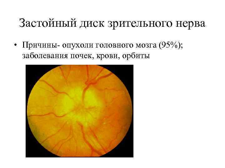 Застойный диск зрительного нерва • Причины- опухоли головного мозга (95%); заболевания почек, крови, орбиты