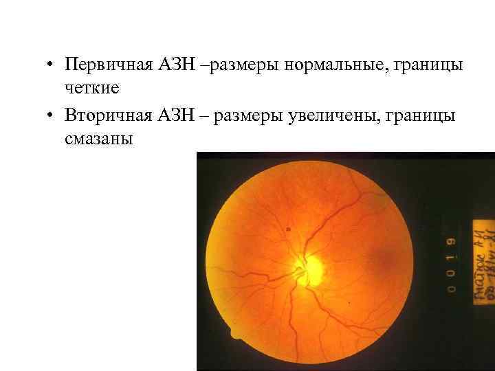  • Первичная АЗН –размеры нормальные, границы четкие • Вторичная АЗН – размеры увеличены,
