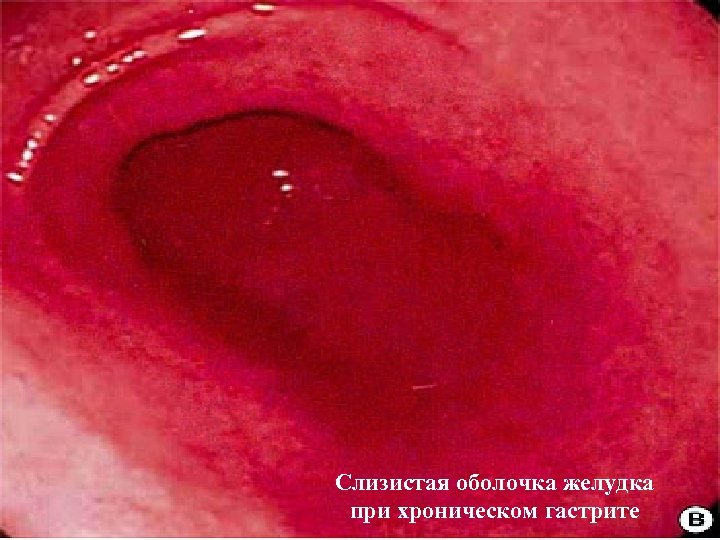 Слизистая оболочка желудка при хроническом гастрите 