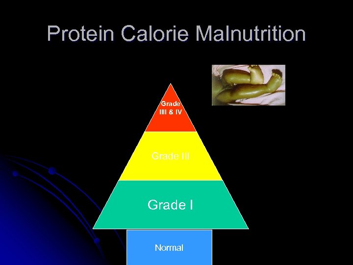 Protein Calorie Malnutrition Grade IIII & IV Grade III Grade I Normal 