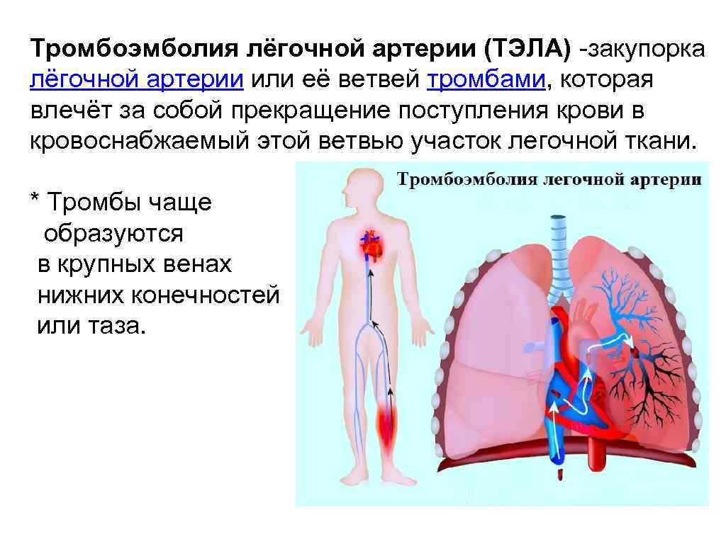 Тромбоэмболия легочной мелких артерий
