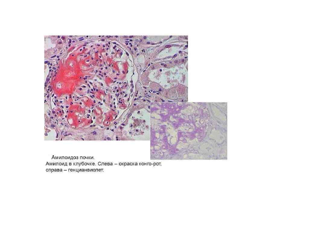 Амилоидоз почек. Амилоидоз почек гистология. Амилоидоз почки микропрепарат. Амилоидный нефроз микропрепарат.