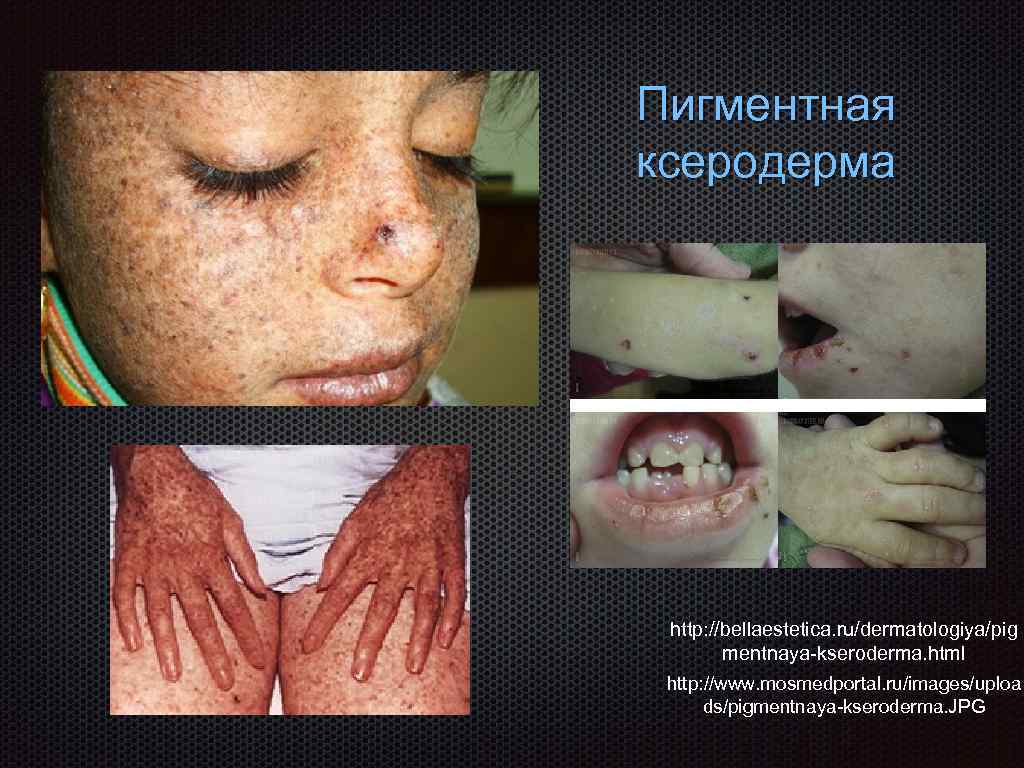 Пигментная ксеродерма http: //bellaestetica. ru/dermatologiya/pig mentnaya-kseroderma. html http: //www. mosmedportal. ru/images/uploa ds/pigmentnaya-kseroderma. JPG 