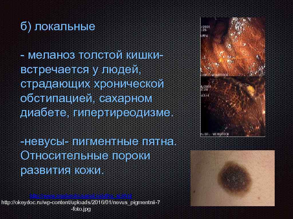 б) локальные - меланоз толстой кишкивстречается у людей, страдающих хронической обстипацией, сахарном диабете, гипертиреодизме.