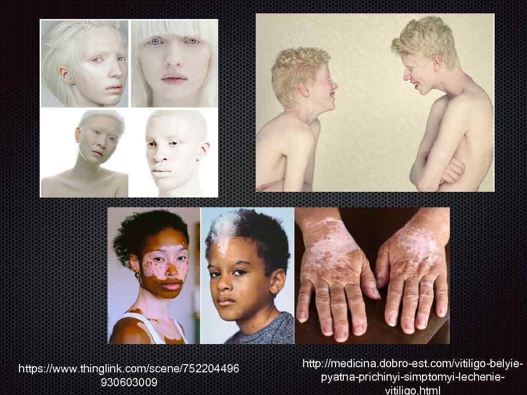 https: //www. thinglink. com/scene/752204496 930603009 http: //medicina. dobro-est. com/vitiligo-belyiepyatna-prichinyi-simptomyi-lechenievitiligo. html 