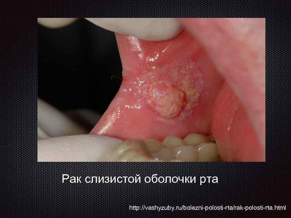 Рак слизистой оболочки рта http: //vashyzuby. ru/bolezni-polosti-rta/rak-polosti-rta. html 
