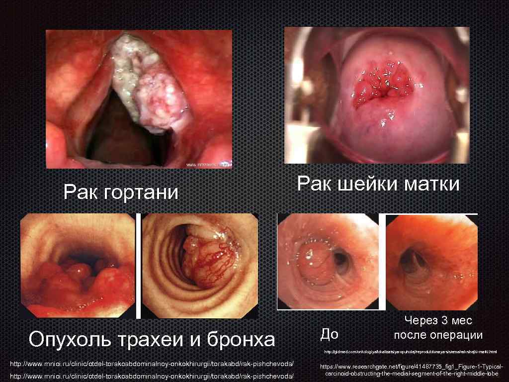 Рак гортани Опухоль трахеи и бронха http: //www. mnioi. ru/clinic/otdel-torakoabdominalnoy-onkokhirurgii/torakabd/rak-pishchevoda/ Рак шейки матки До