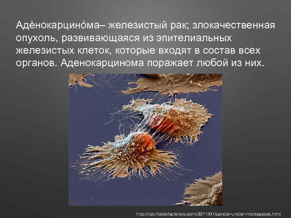 Адèнокарцинóма– железистый рак; злокачественная опухоль, развивающаяся из эпителиальных железистых клеток, которые входят в состав