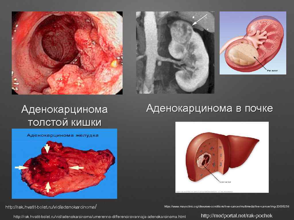 Аденокарцинома толстой кишки http: //rak. hvatit-bolet. ru/vid/adenokarcinoma/ Аденокарцинома в почке https: //www. mayoclinic. org/diseases-conditions/liver-cancer/multimedia/liver-cancer/img-20006258