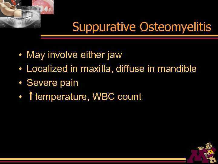 Suppurative Osteomyelitis • May involve either jaw • Localized in maxilla, diffuse in mandible