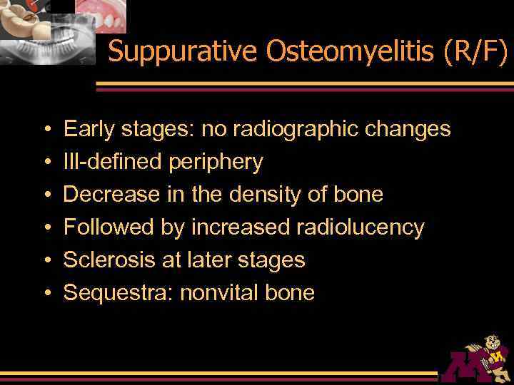 Suppurative Osteomyelitis (R/F) • • • Early stages: no radiographic changes Ill-defined periphery Decrease