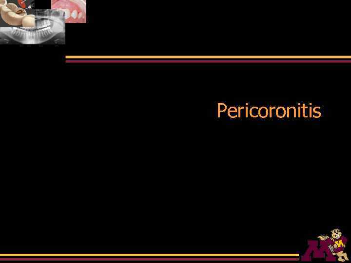 Radiographic Interpretation of Infections of Jaws Pericoronitis