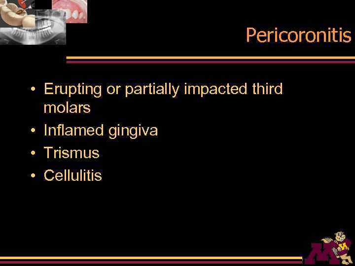 Pericoronitis • Erupting or partially impacted third molars • Inflamed gingiva • Trismus •