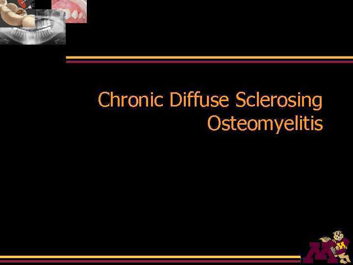 Chronic Diffuse Sclerosing Osteomyelitis 