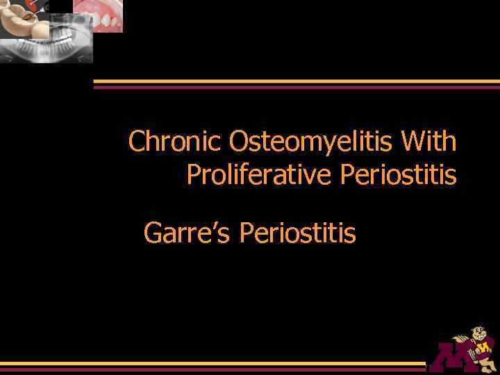 Chronic Osteomyelitis With Proliferative Periostitis Garre’s Periostitis 