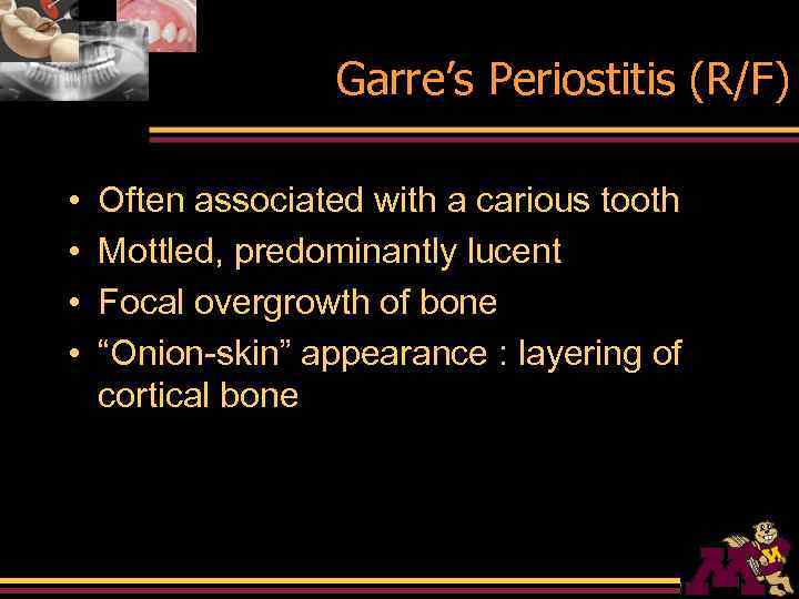 Garre’s Periostitis (R/F) • • Often associated with a carious tooth Mottled, predominantly lucent