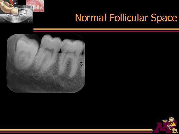 Normal Follicular Space 