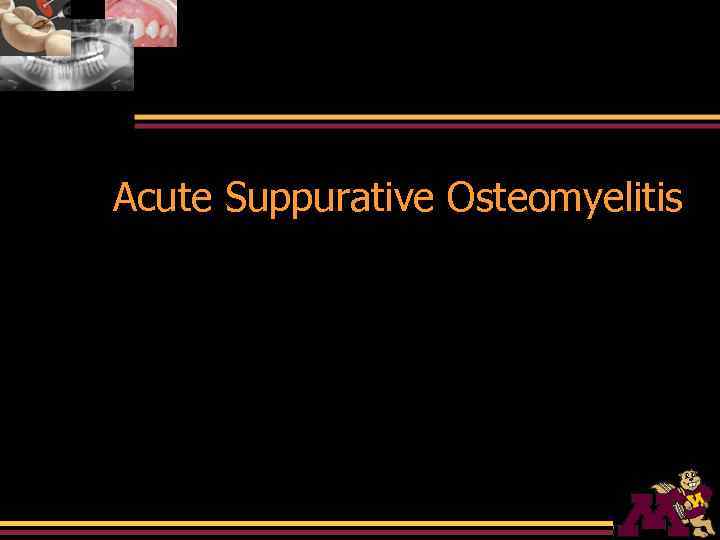 Acute Suppurative Osteomyelitis 