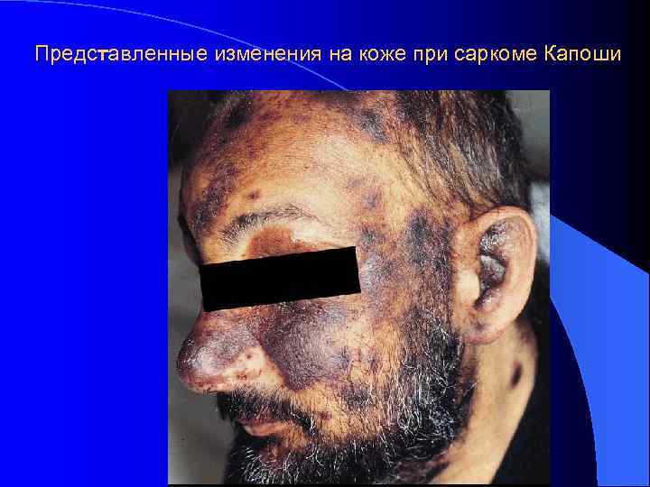 Представленные изменения на коже при саркоме Капоши 