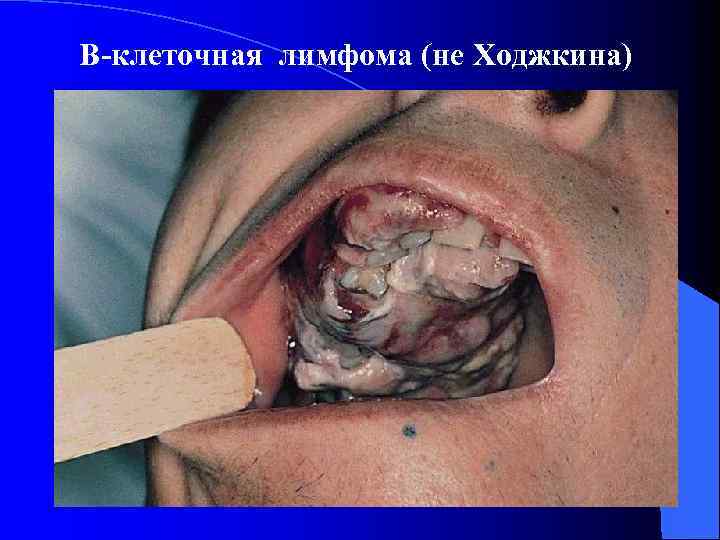 В-клеточная лимфома (не Ходжкина) 