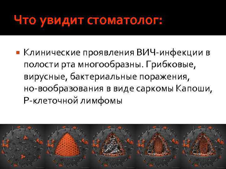 Что увидит стоматолог: Клинические проявления ВИЧ инфекции в полости рта многообразны. Грибковые, вирусные, бактериальные