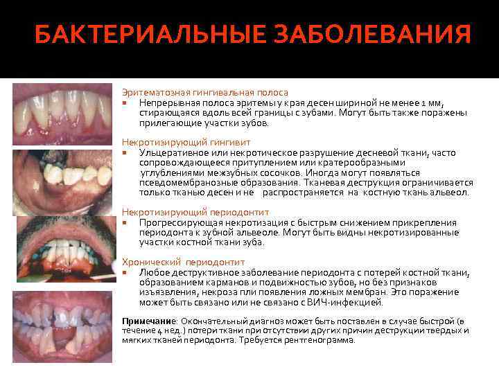 БАКТЕРИАЛЬНЫЕ ЗАБОЛЕВАНИЯ Эритематозная гингивальная полоса Непрерывная полоса эритемы у края десен шириной не менее