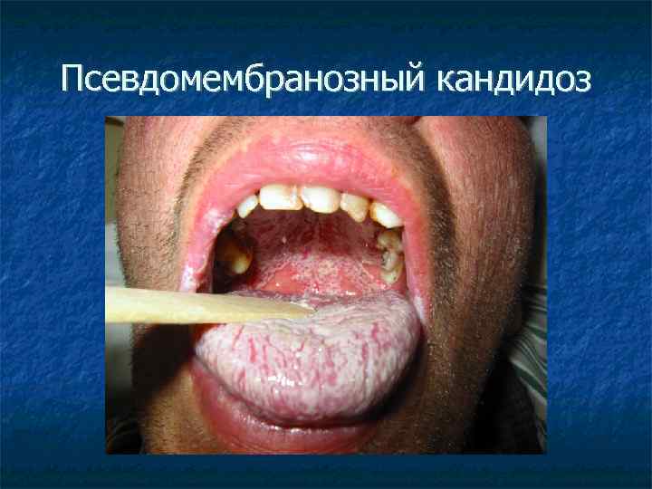 Псевдомембранозный кандидоз 