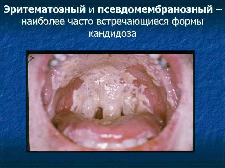 Эритематозный и псевдомембранозный – наиболее часто встречающиеся формы кандидоза 