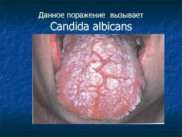 Данное поражение вызывает Candida albicans 