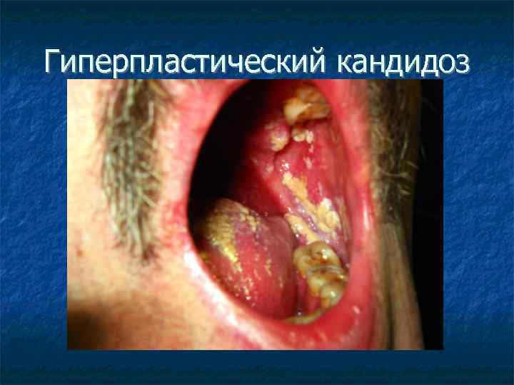 Гиперпластический кандидоз 