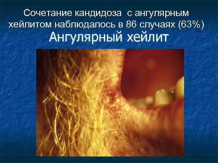 Сочетание кандидоза с ангулярным хейлитом наблюдалось в 86 случаях (63%) Ангулярный хейлит 